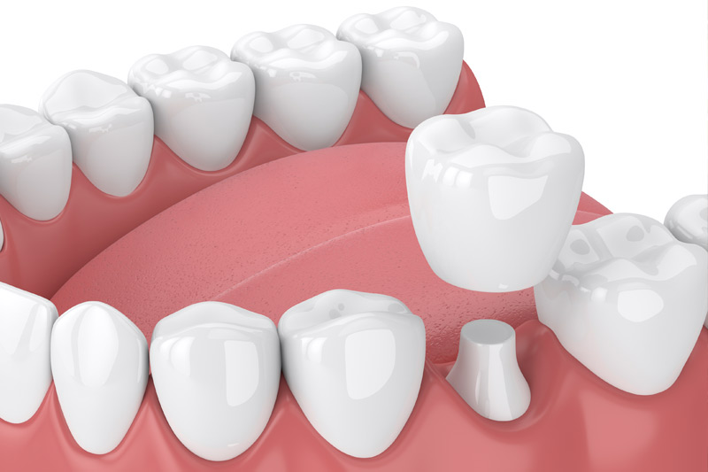 Dental Crowns in Iowa City