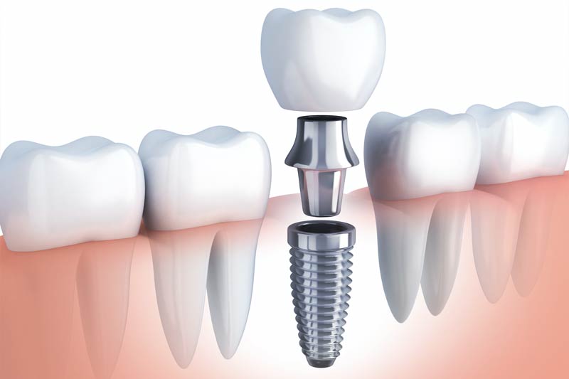 Implants Dentist in Iowa City